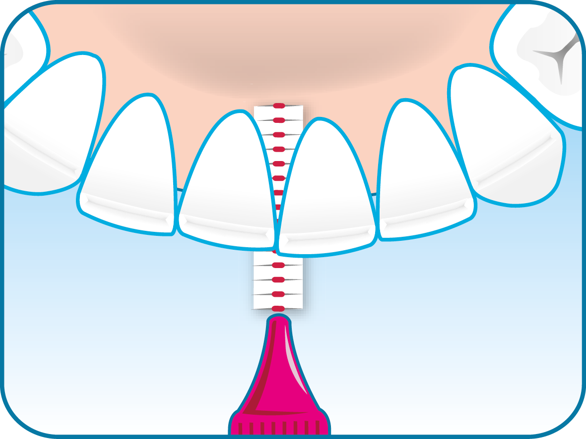 Fogköztisztító kefe helyes használatának 1. lépése az elülső fogak tisztítása. Óvatosan a fogak közé helyezve lassan mozgatva előre és hátra.